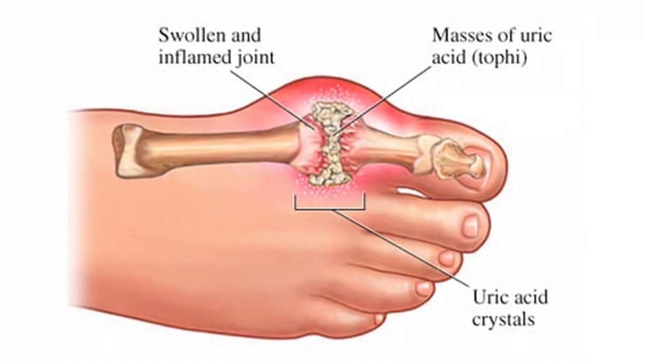 Uric acid crystal dispersment - where can they go?